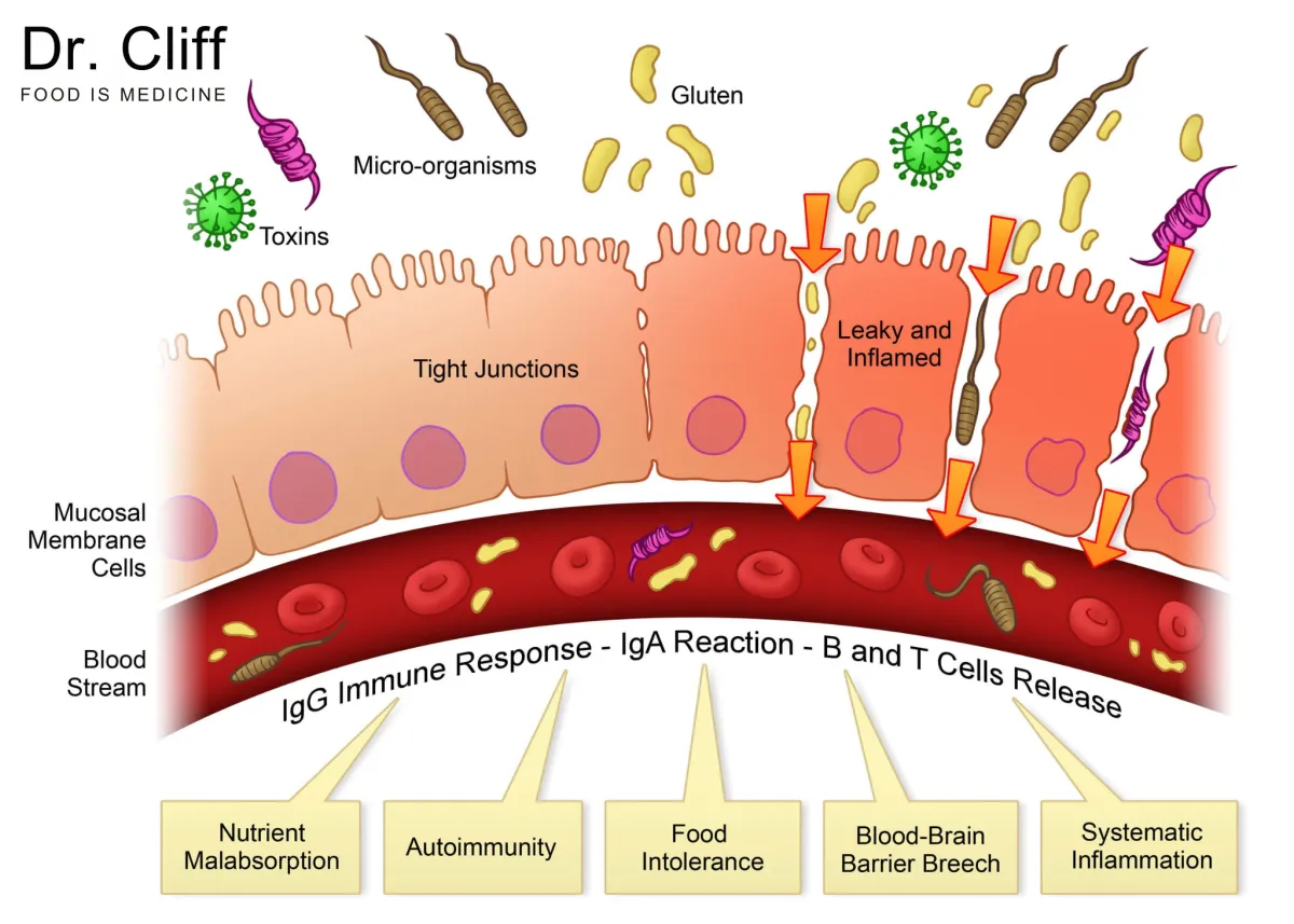 Understanding Leaky Gut: A Functional Medicine Perspective