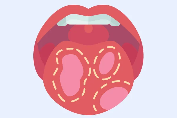 Why do TMD and Burning Mouth Syndrome Often Co-Exist?
