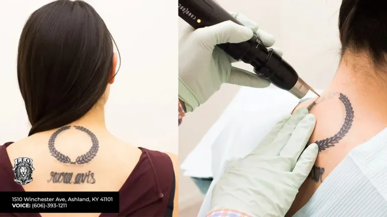A comprehensive guide for tattoo removal in Ashland, KY