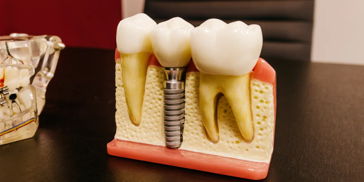 Learn how same-day dental implants in Englewood work