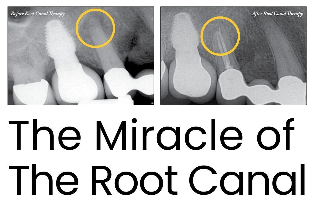 The Miracle of the Root Canal