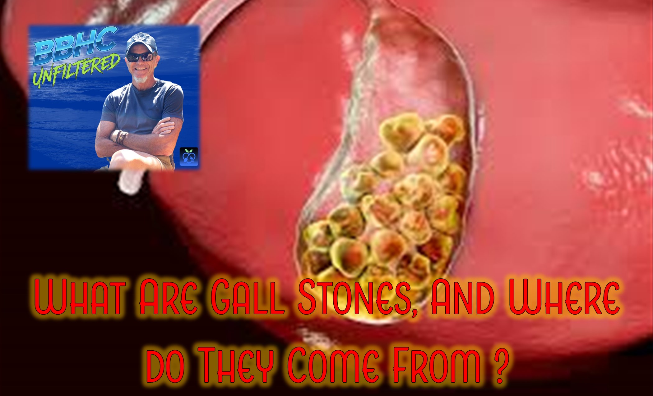 Understanding Gallstones and Their Symptoms
