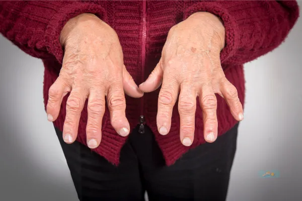 A senior lady showing Hand Joints Nuckles