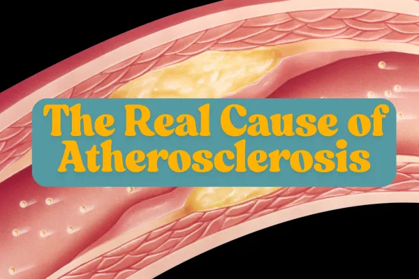 Conceptual image of an artery with inflamed and damaged inner lining, showing oxidized LDL accumulation and immune cell infiltration—highlighting the role of inflammation in heart disease over cholesterol alone.
