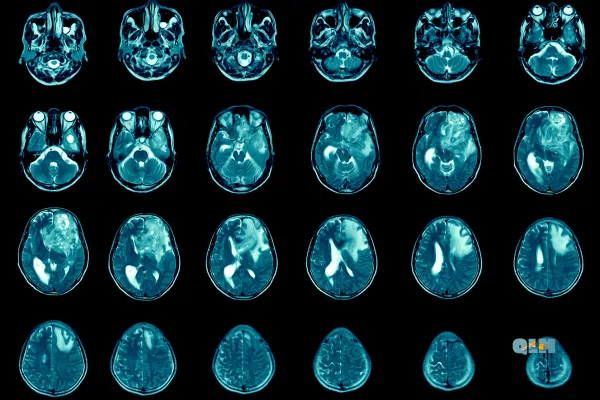 Starving Cancer: Dr. Thomas Seyfried’s Metabolic Therapy for Glioblastoma

