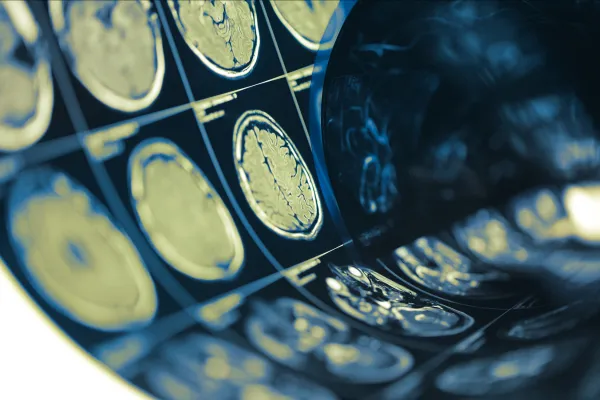 Metabolic Therapy and Glioblastoma: A New Approach