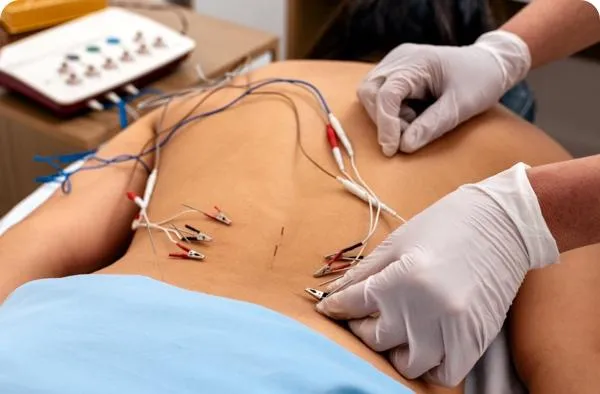 Dry Needling vs Acupuncture: Key Differences, Benefits & What’s Best for You