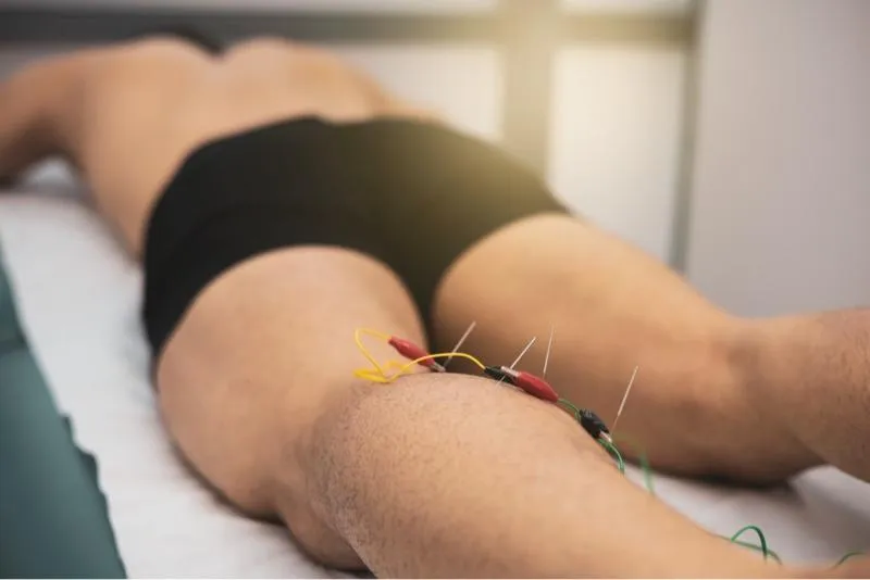 The Benefits of Dry Needling for Pain Management and Muscle Recovery