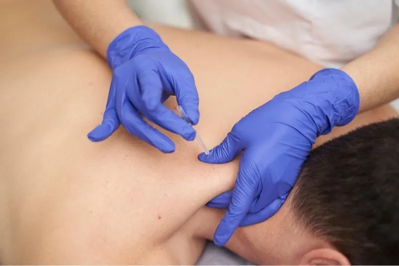 What is Dry Needling and How Does it Work?