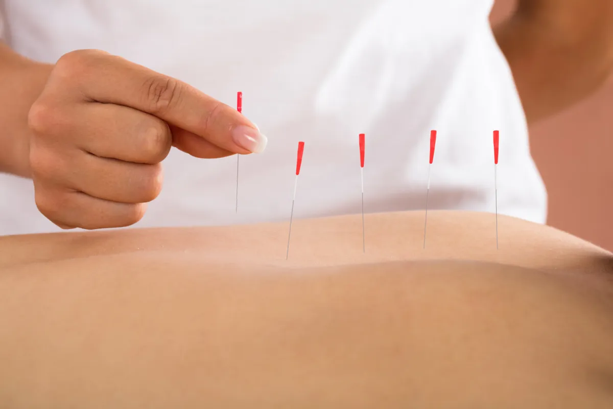 Post Dry Needling Care: What to Expect After Your Session