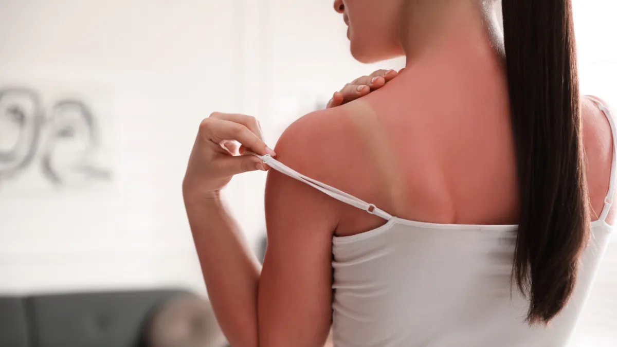women with a sunburn