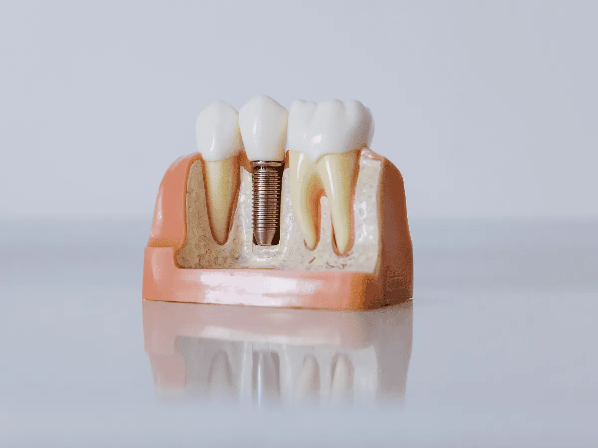 Everything You Need to Know About Dental Implants