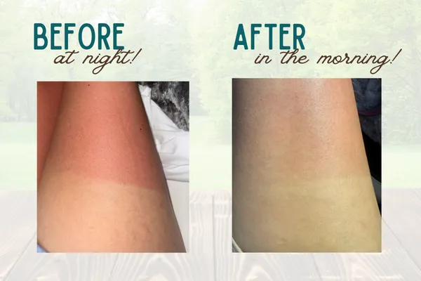 Got a Sunburn? I got you!