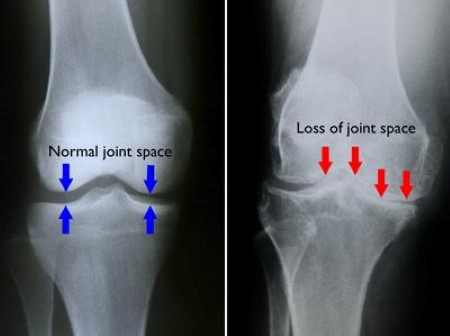 Comparison of knee arthritis, tendon pain, and meniscus injury showing different sources of knee pain