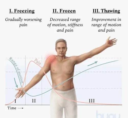 Adult attempting to reach behind their back and stopping due to severe shoulder stiffness, showing limited range of motion consistent with frozen shoulder