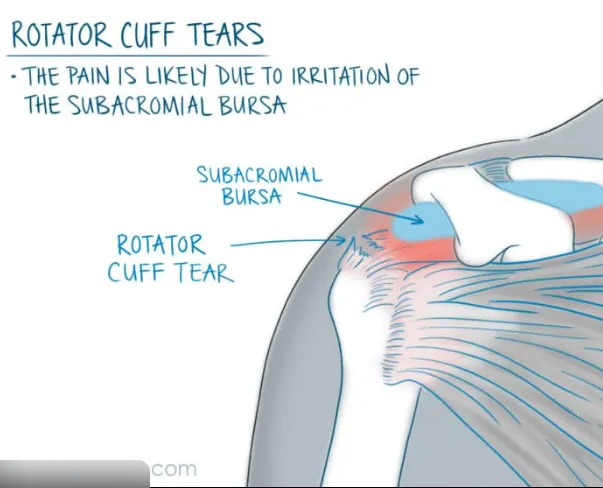 Shoulder Pain After Sleeping Caused by Pillow and Sleeping Mechanics