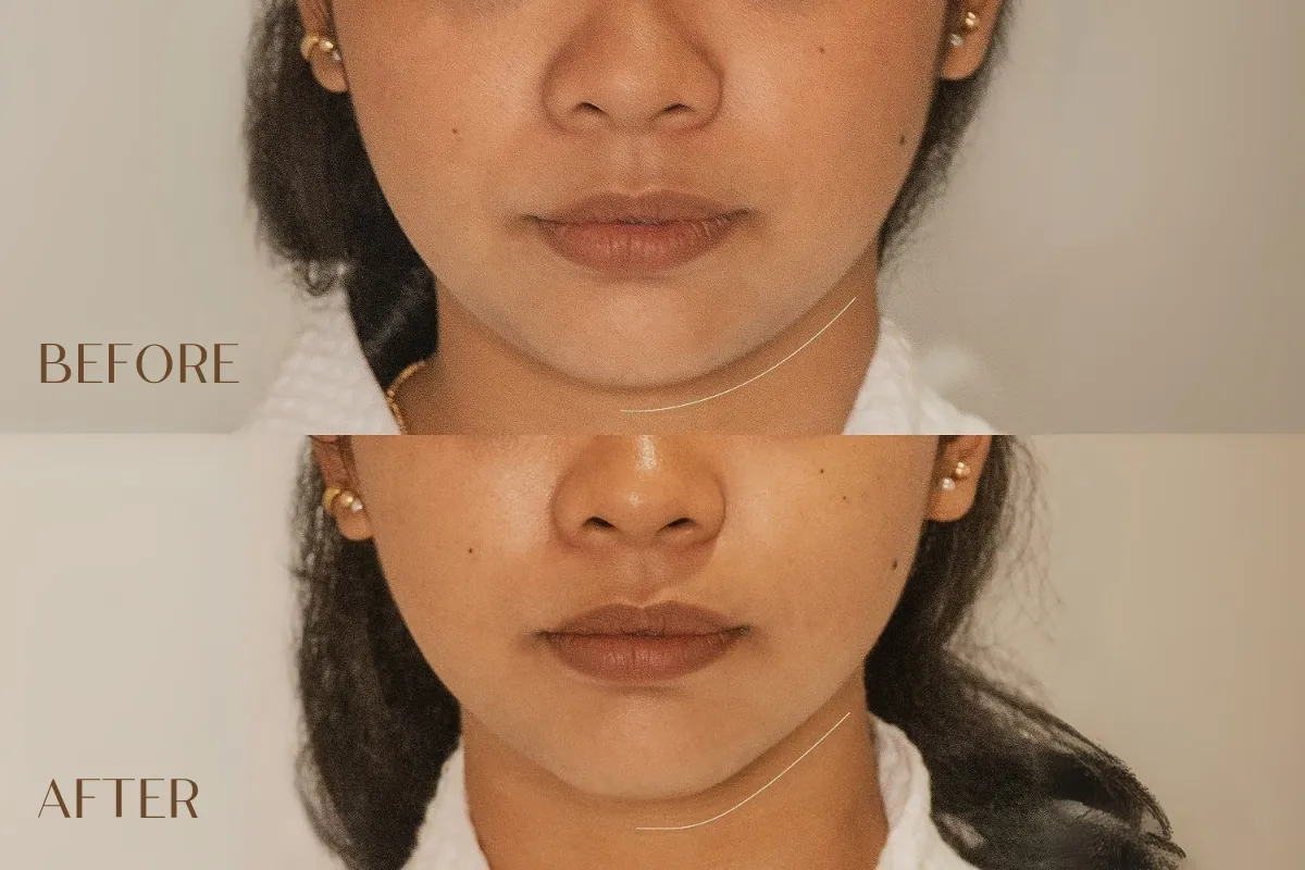 Chisel Without Surgery: V Contour’s Secret to Instant Definition