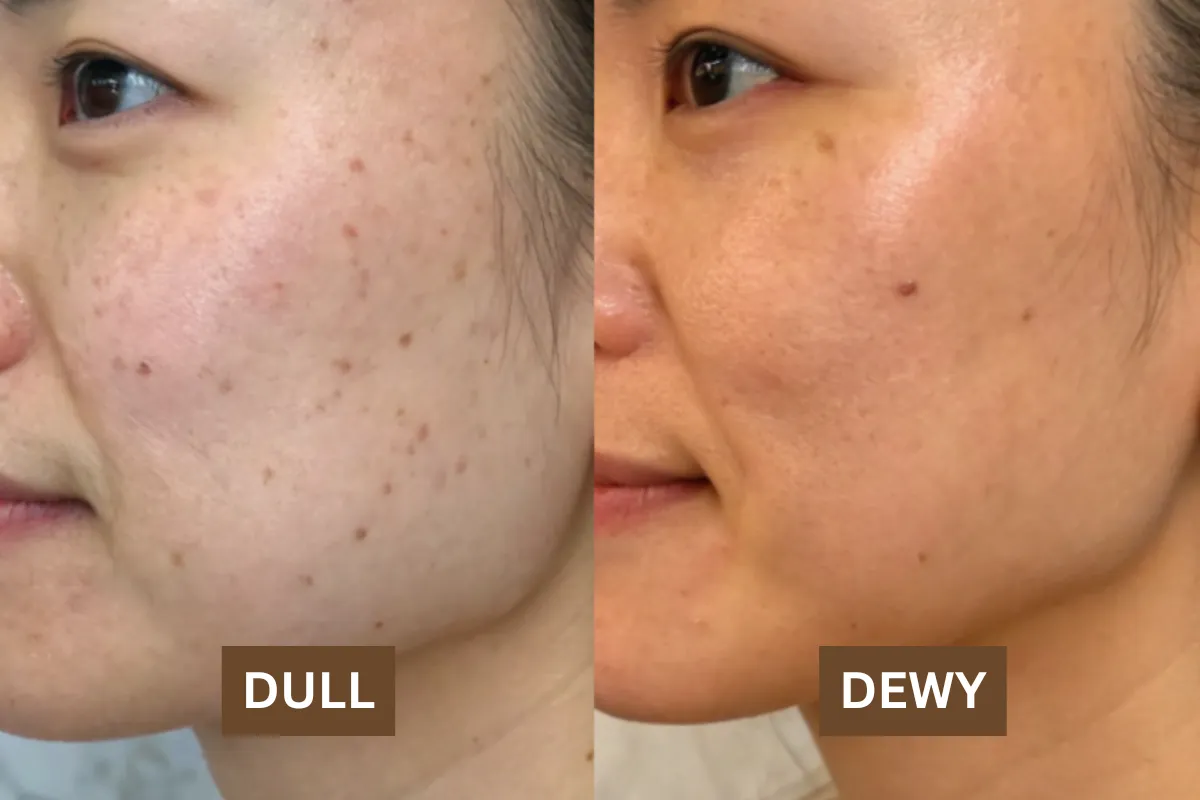 From Dull to Dewy: The Science Behind Radiance-Boosting Treatments