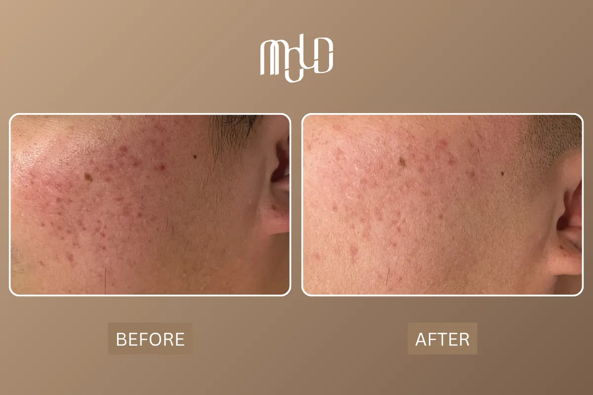 Acne Scar Treatment Options: What Really Works for Your Skin