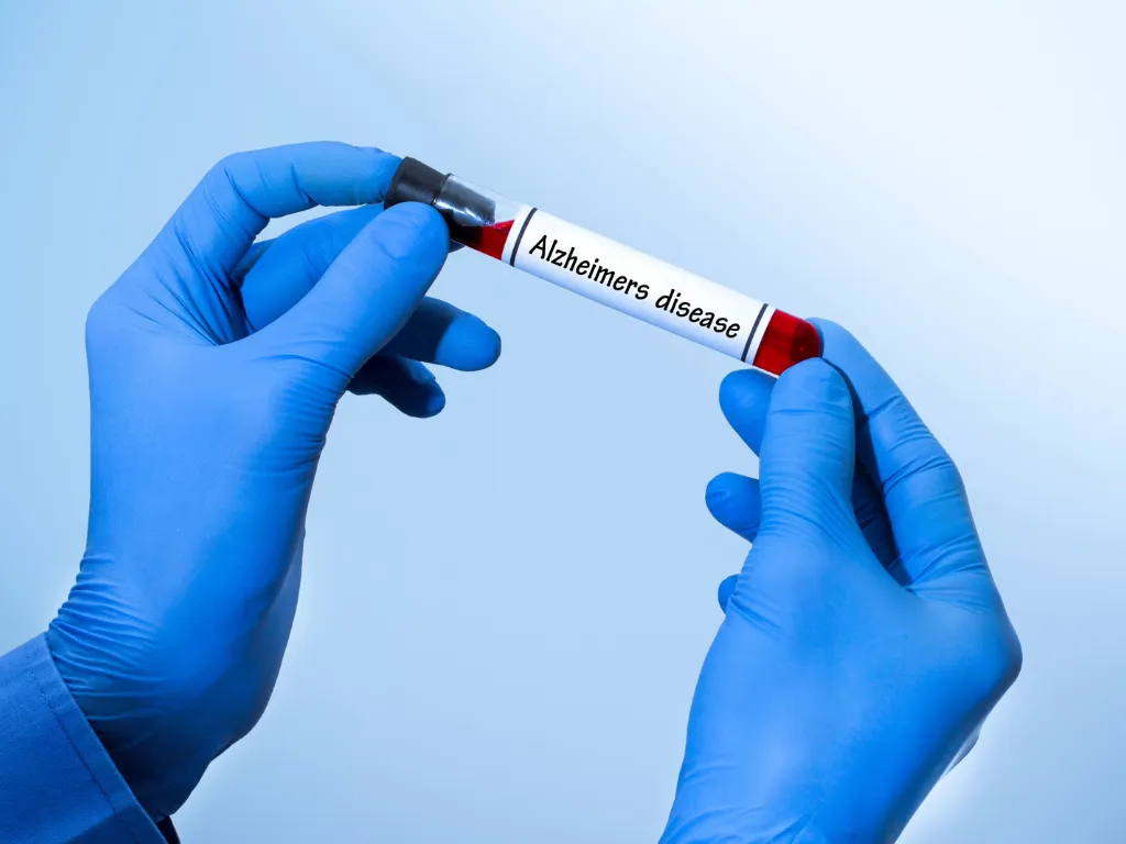 Test tube with Alzheimer's disease label