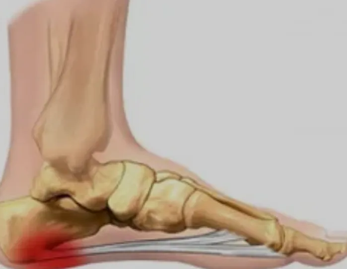 Fascite Plantar