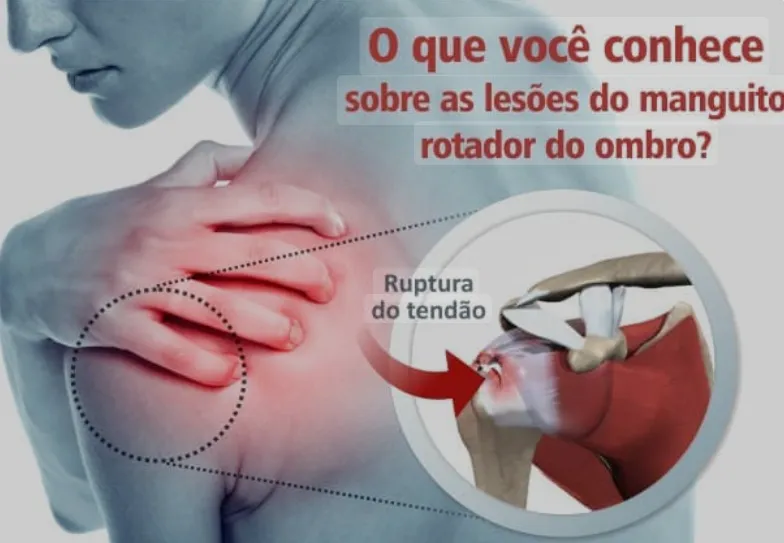 síndrome do impacto do ombro
