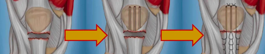Ruptura do Aparelho Extensor do Joelho: Causas, Sintomas e Tratamentos | Dr. Jefferson De Decco