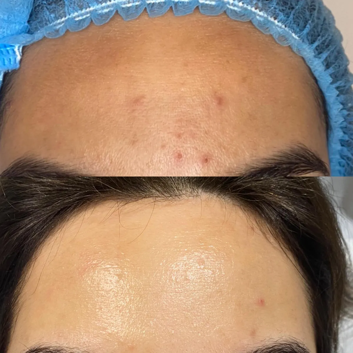 Acne treatment