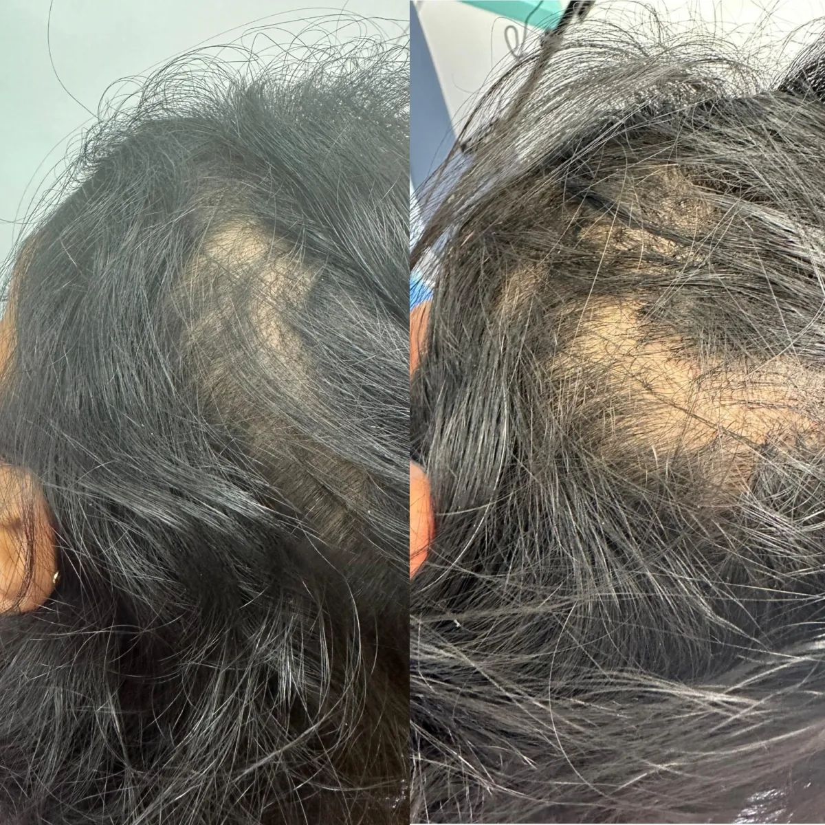 Hair loss treatment
