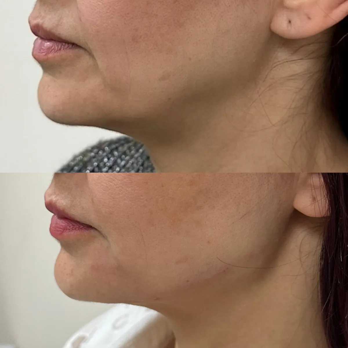 Jawline filler