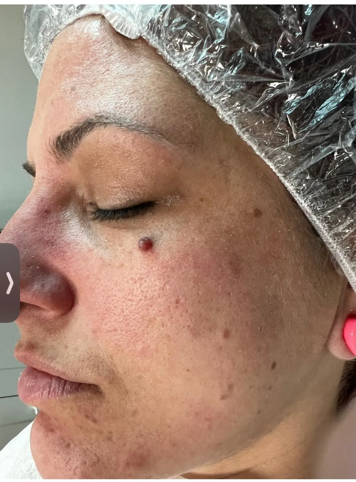 skin-tags-marlborough-ma