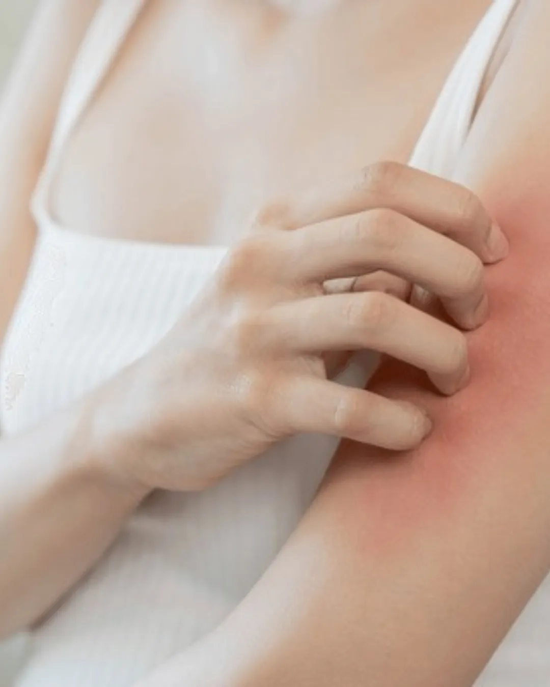 A photograph of Skin allergies due to pest