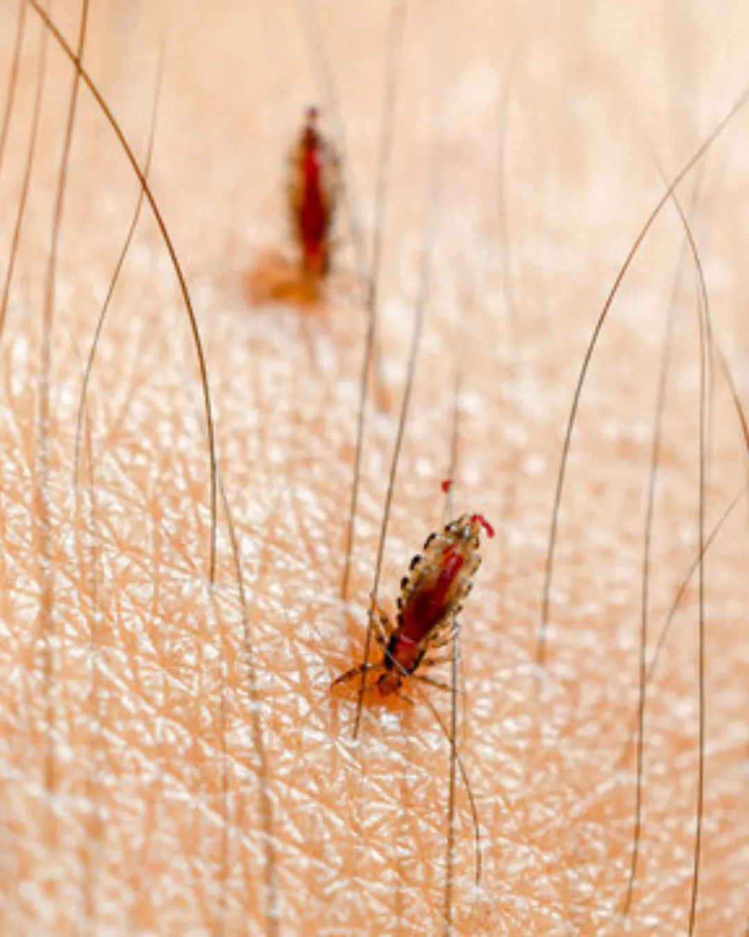 An image showing lice in the scalp