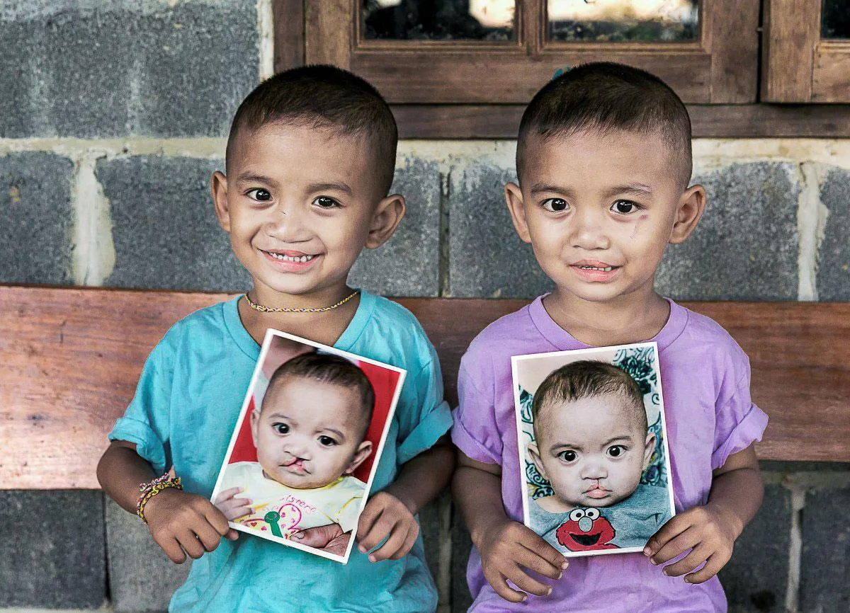 operation-smile