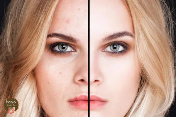 Introducing ProCell Microchanneling: The Future of Skin Rejuvenation