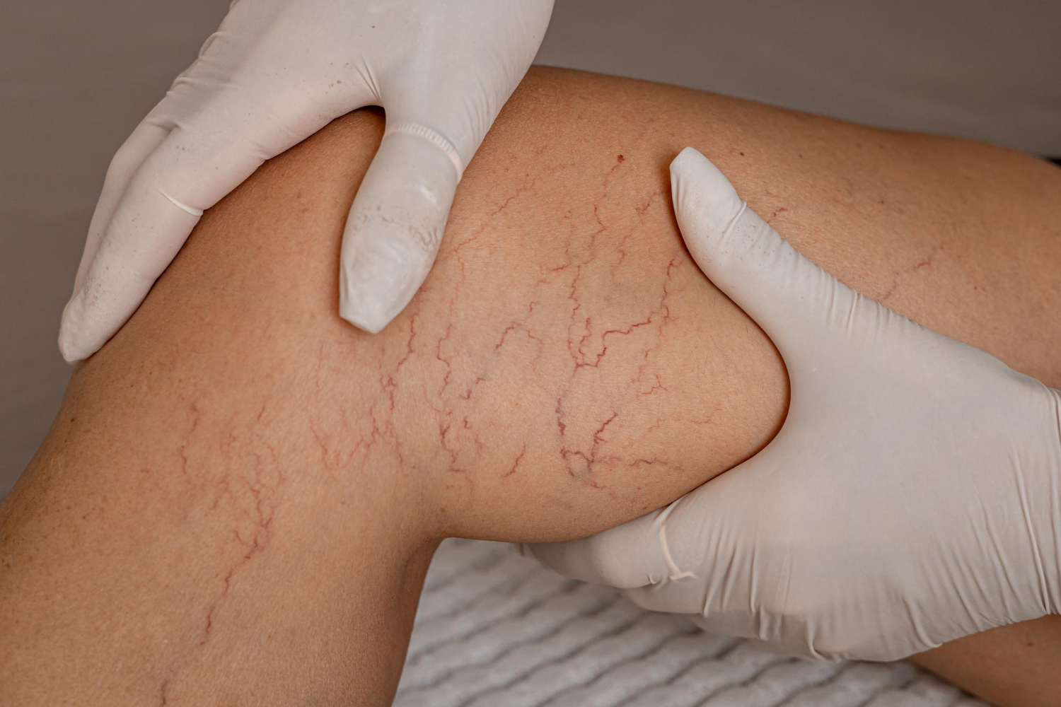 Holiday Plans Affected by Spider Vein Treatment Timing