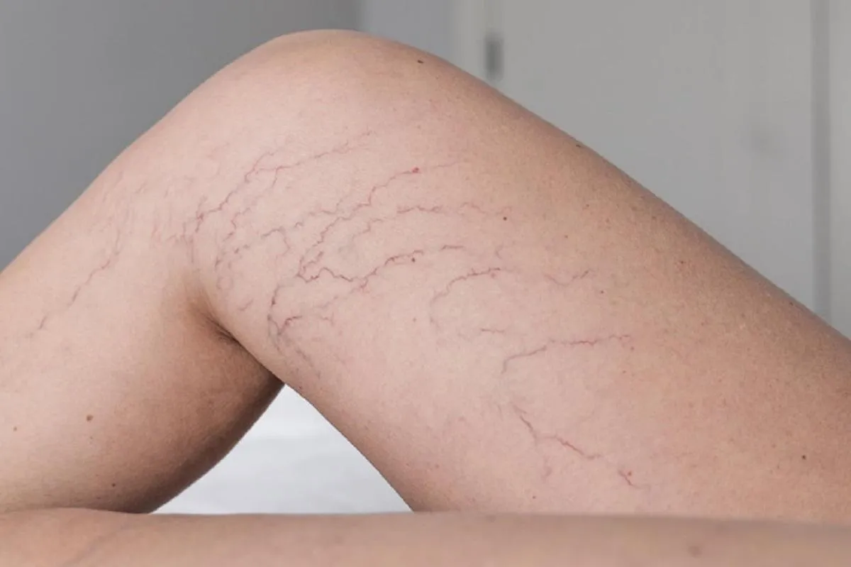 What to Know About Spider Vein Removal Before Spring Arrives