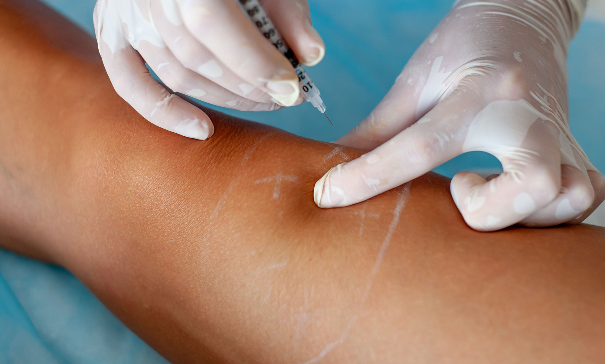 How Sclerotherapy Services Ease Everyday Discomfort