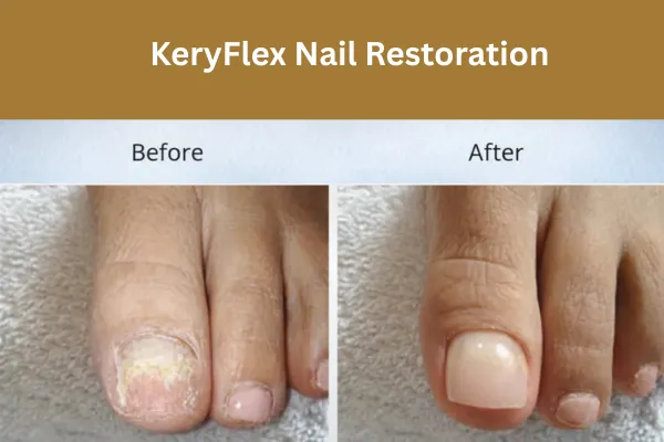 KeryFlex nail restoration for damaged or fungal toenails