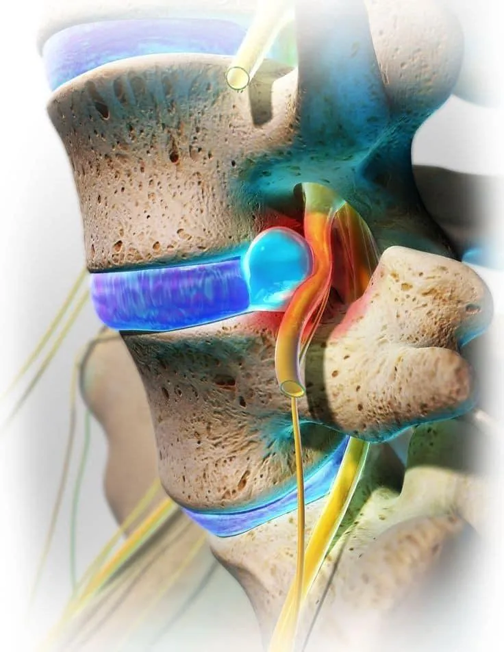 Detailed 3D medical illustration showing a herniated lumbar disc compressing the sciatic nerve root, used by Vanguard Chiropractic in Tulsa’s Brookside area to explain the source of sciatica pain.