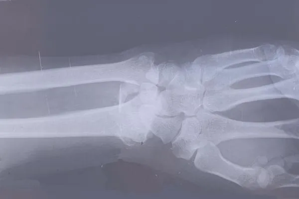 x-ray of wrist