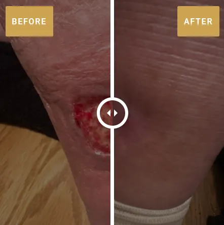 5 Steps You Can Take to Speed Up Your Chronic Wound Healing