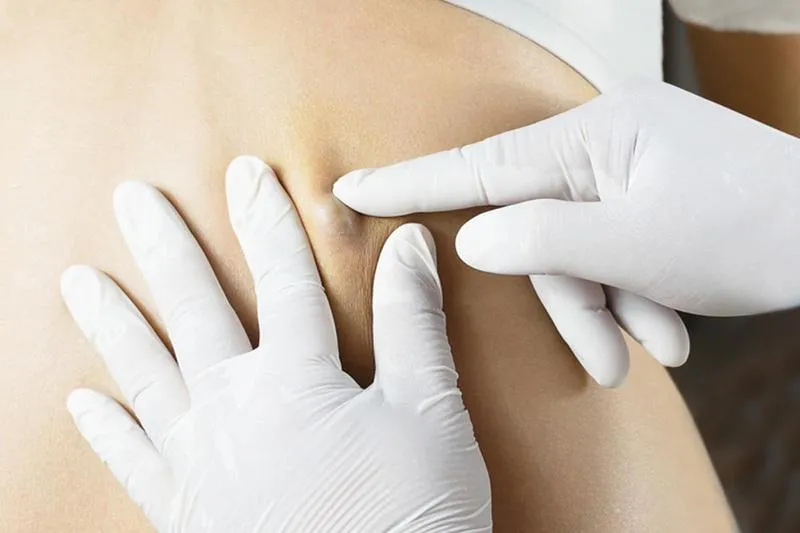Quiste Sebáceo o Lipoma, ¿cuál es la diferencia?
