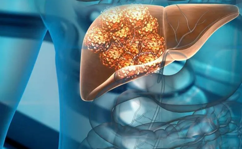¿Qué es la Hepatitis?