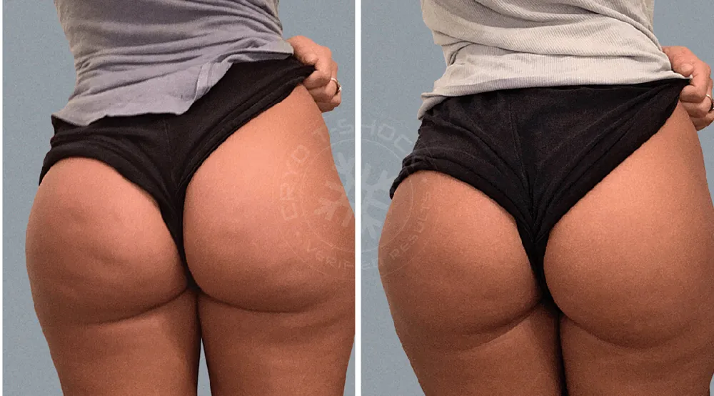 Cellulite Reduction