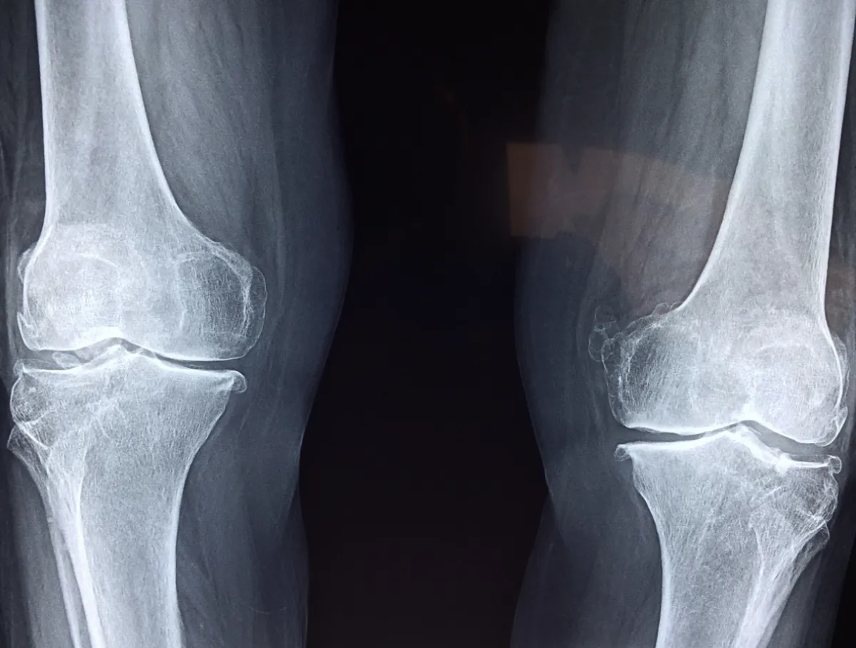 "Bone-on-bone" sounds scary but it's asymptomatic for some people!