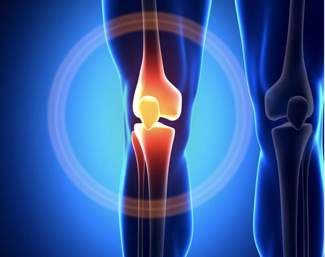 New Cutting-Edge Knee Relief--Without The Cutting!