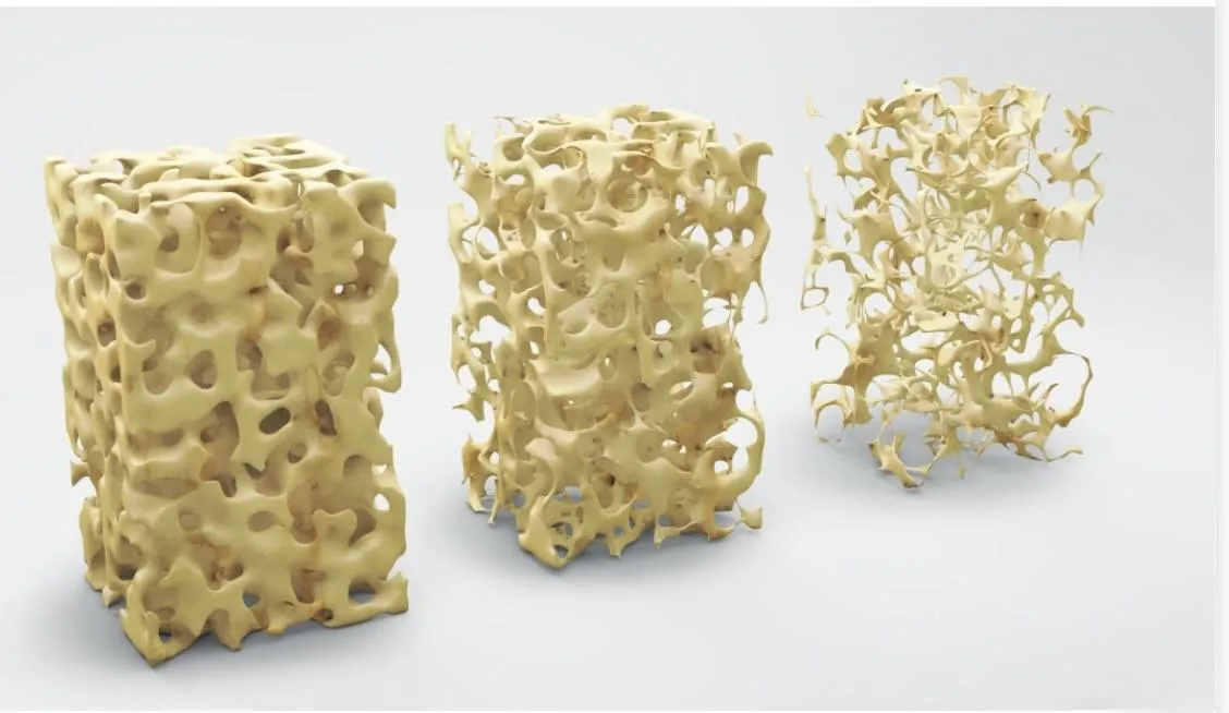 Optimally healthy bones are both dense and high quality.