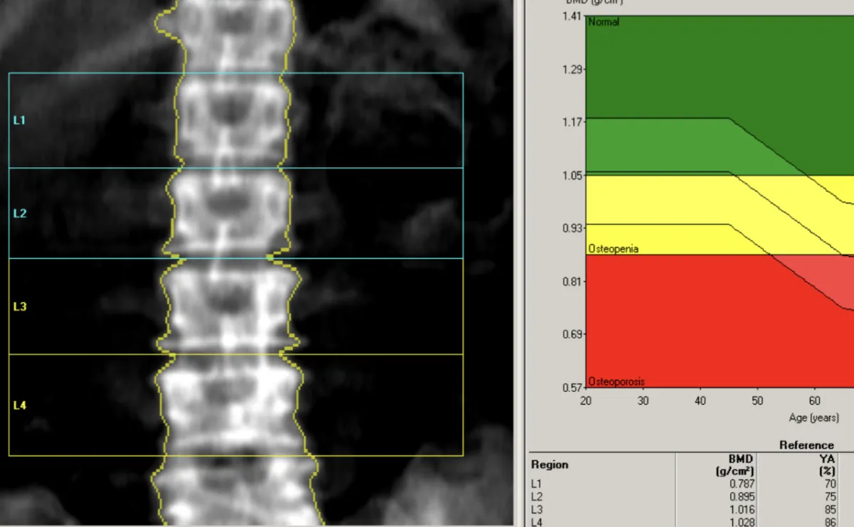 It Improved My Bone Density—Something I Didn't See Coming