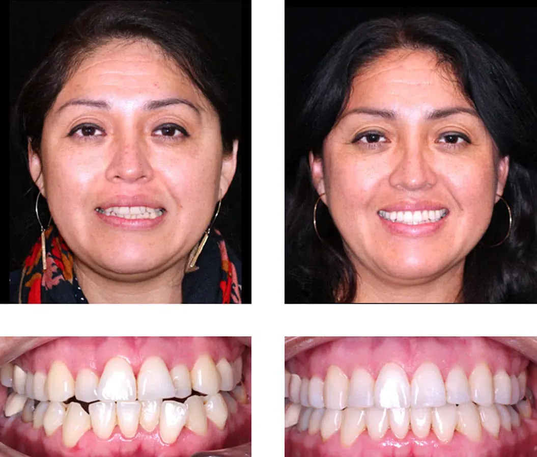 What to Expect During Your Invisalign Treatment Journey